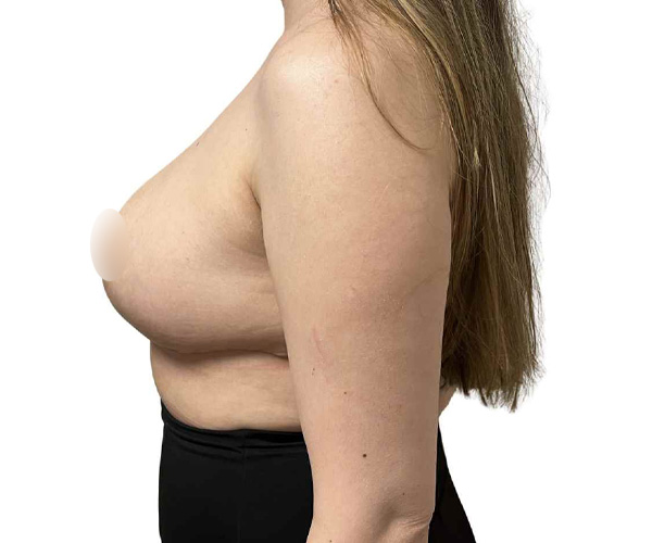 after breast reduction Santa Monica side view