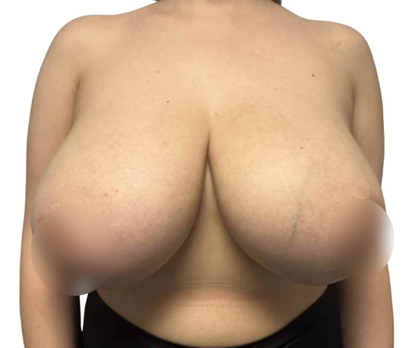 before breast reduction Santa Monica front