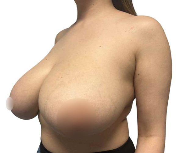 before breast reduction Santa Monica angle view