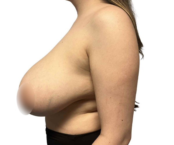 Before breast reduction Santa Monica side view