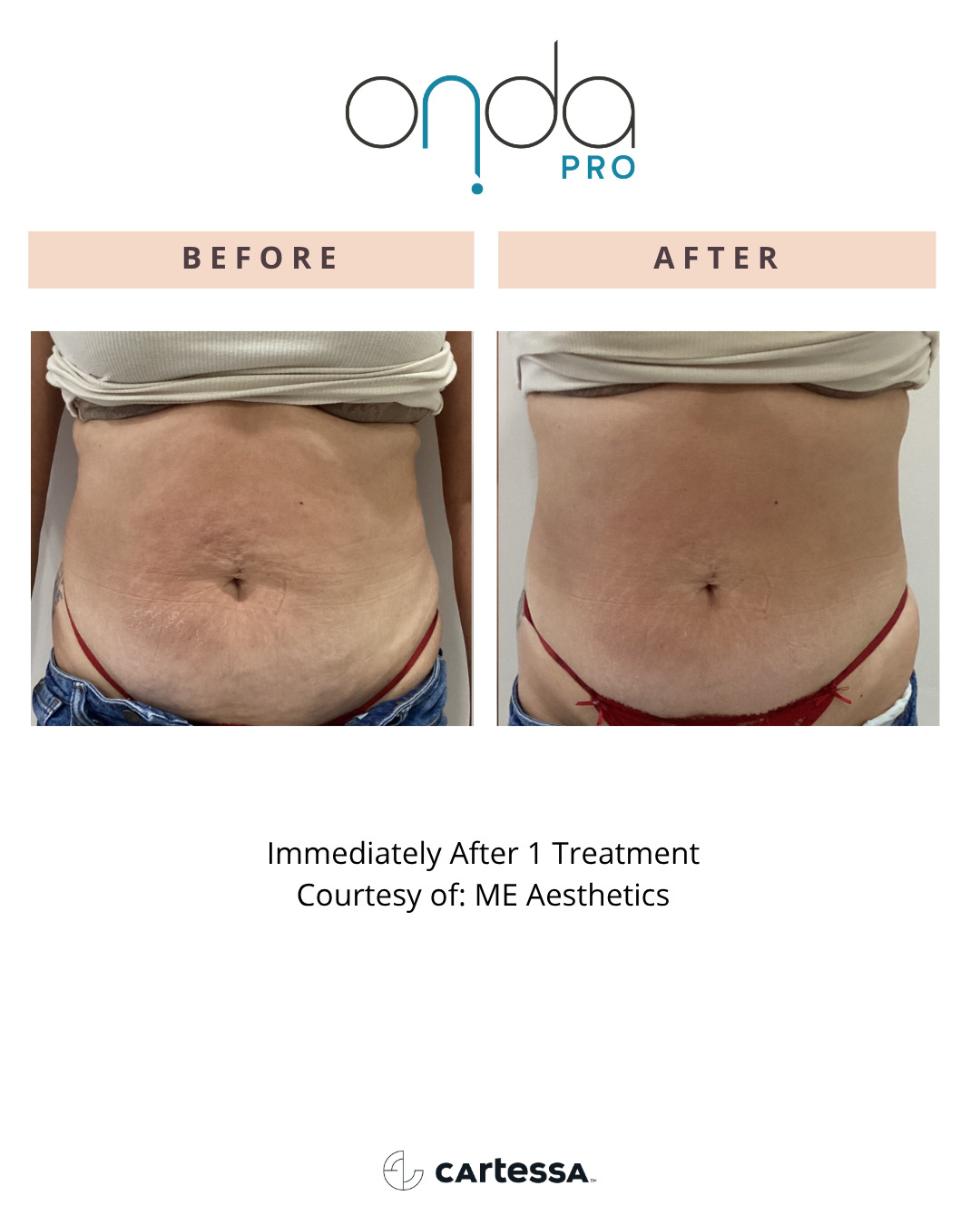 onda pro before and after santa monica