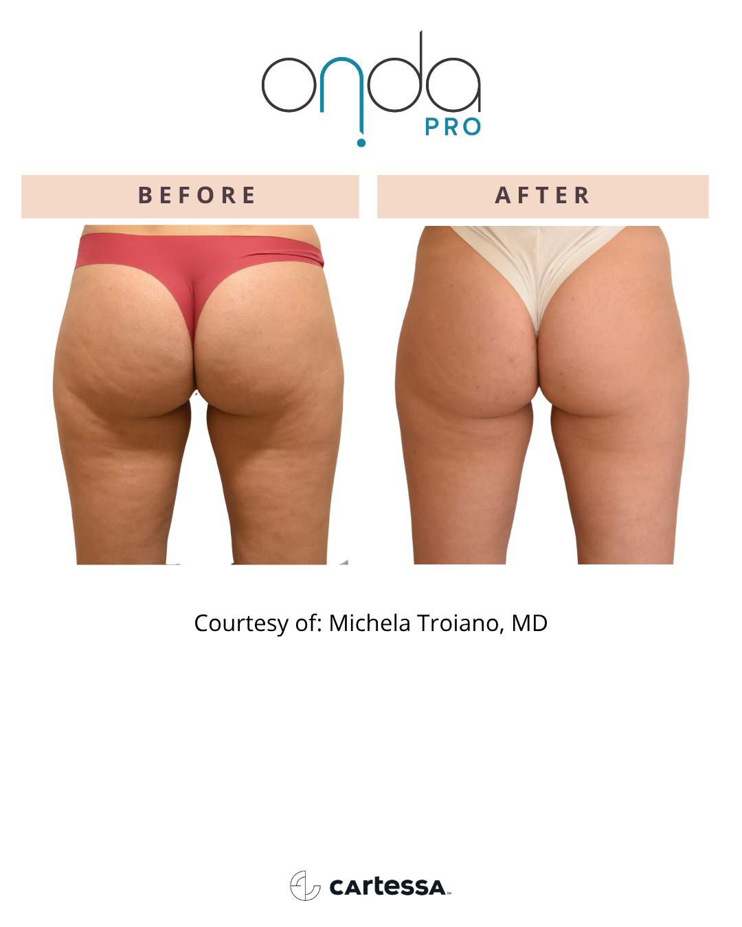 santa monica before and after onda pro body contouring